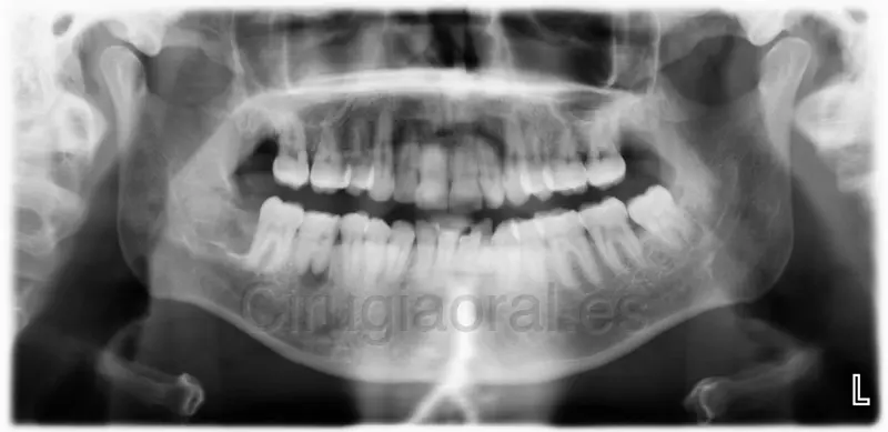 Radiografía panorámica de las dos arcadas después de la cirugía