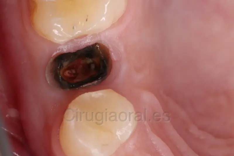 Foto intraoral de un molar del que solo queda la raíz, con la cavidad abierta