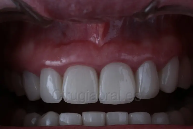 Primer plano de una boca con los dientes de arriba y de abajo rehabilitados