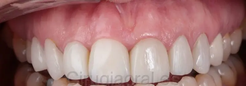 Primer plano de una boca rehabilitada: los dientes de arriba, completos, vistos de frente